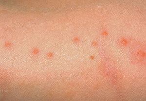 bedbug-bites-zigzag
